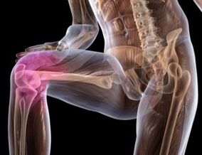 Hogyan kezeljük a térddeformáló artrózist. Zúzódott hátizmok kezelése